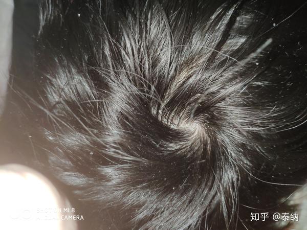 头顶漩涡处这样正常吗