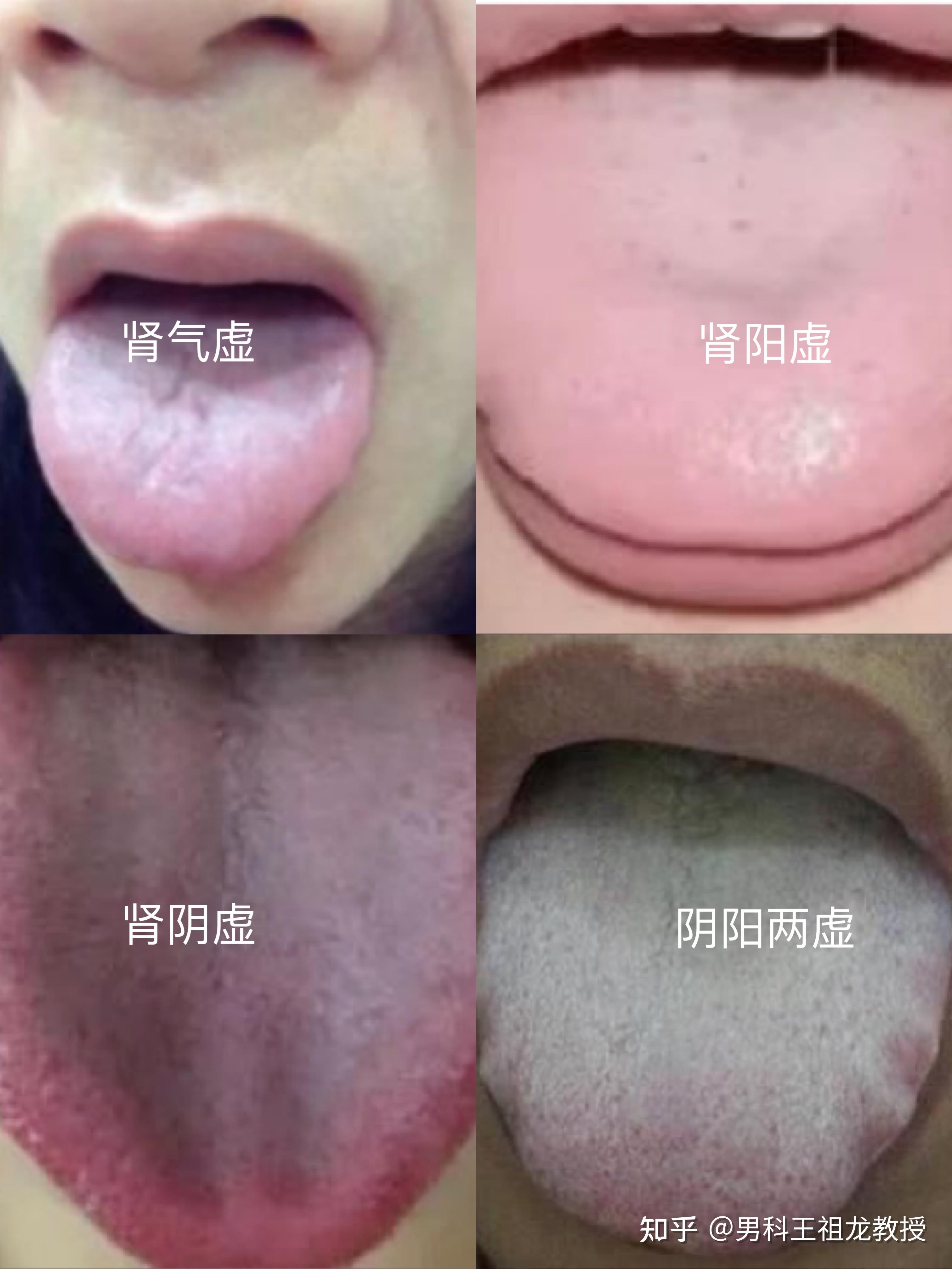 肾虚舌苔的表现图图片