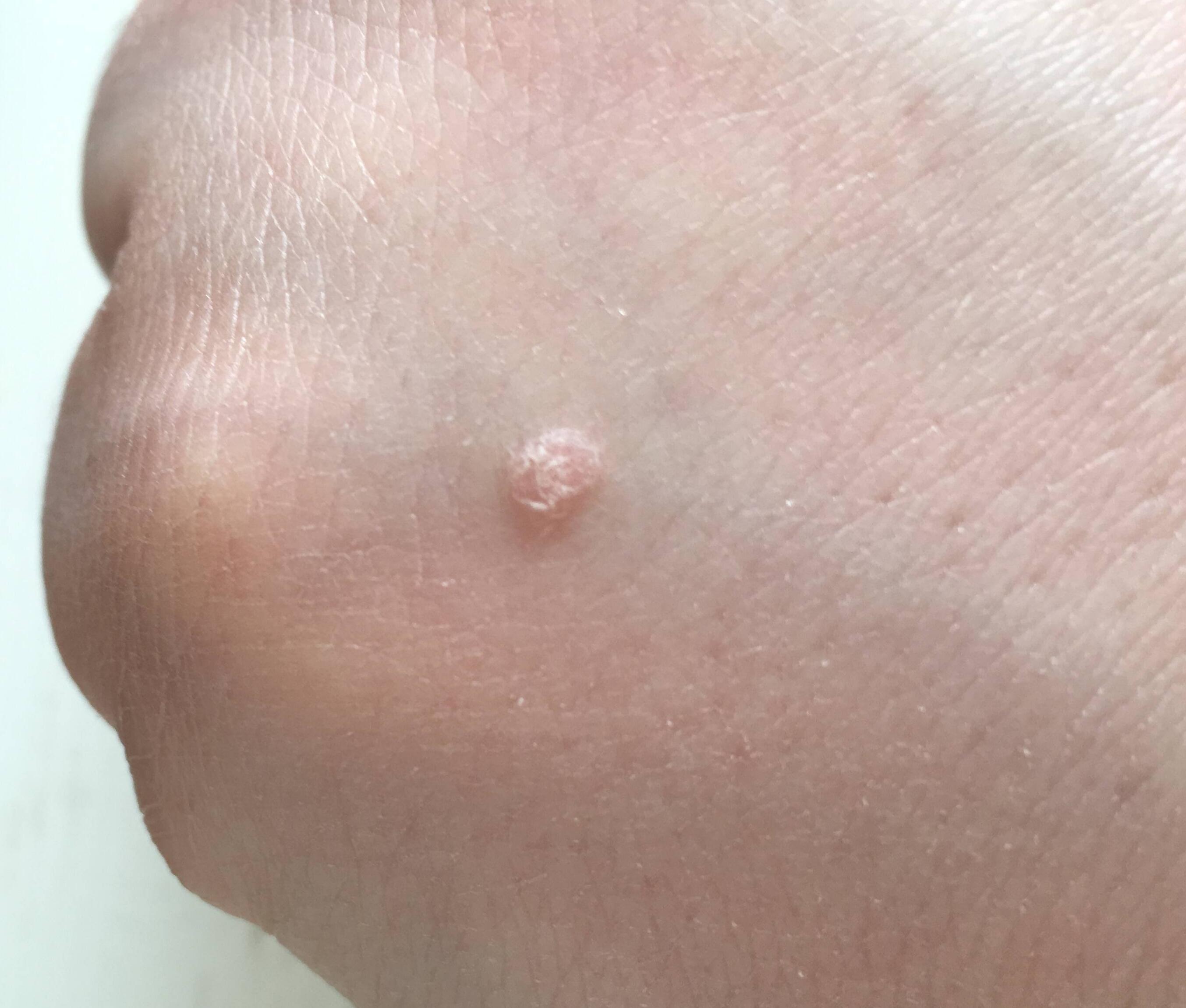 小时候,手上长了一颗寻常疣,我们这里叫鱼鳞缀,看着碍眼,经常抠它