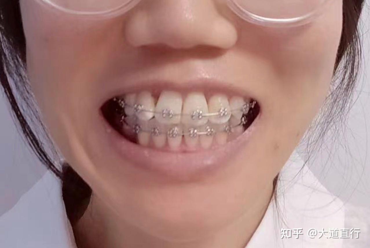 不齐的牙齿也可以有整齐的笑容 - 贝致案例库 - 贝致——专业口腔服务平台，权威医生，真实案例，一次看够