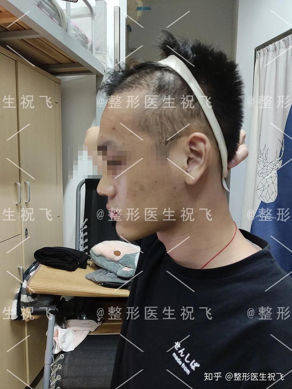 额角脱发的原因是什么?能否通过植发治疗? - 知乎