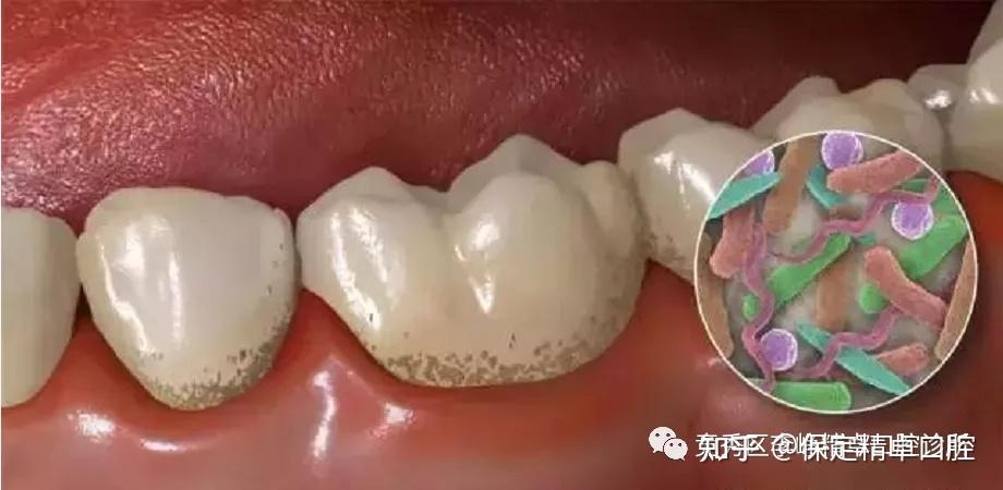 什么是牙齿脱矿?牙齿为什么会脱矿? - 知乎