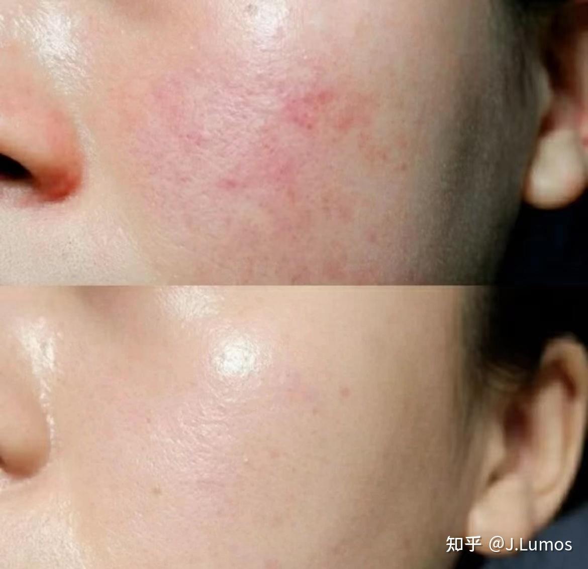 敏感肌脸颊泛红怎么修复，如何修复敏感肌脸红?_哔哩哔哩_bilibili