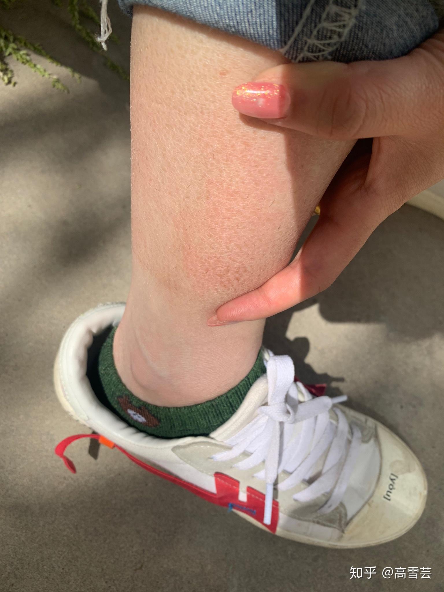 谁能帮我看下我的腿部皮肤咋回事小腿不疼不痒就是看着恶心