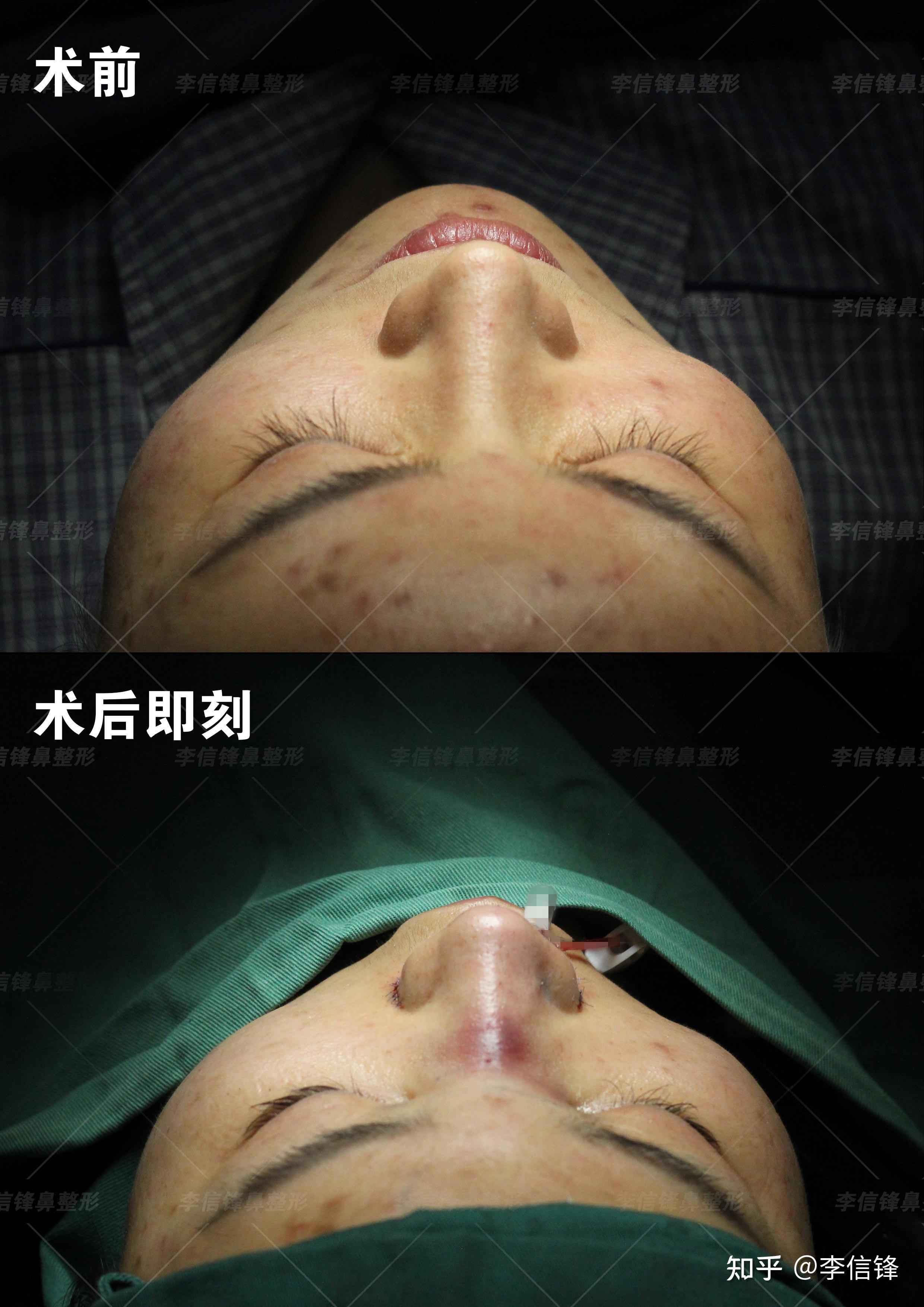 从锐感到柔情,圆润的鼻头更符合当下的审美!箭头鼻修复案例,术后即刻对比分享,感受鼻尖美的转变!—深圳李信锋隆鼻综合整形案例分享 - 知乎