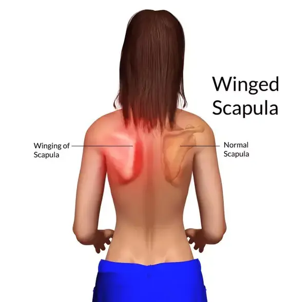 一方面涉及到胸长神经损伤,这可能是因为跌倒的时候神经被撕扯,贿者
