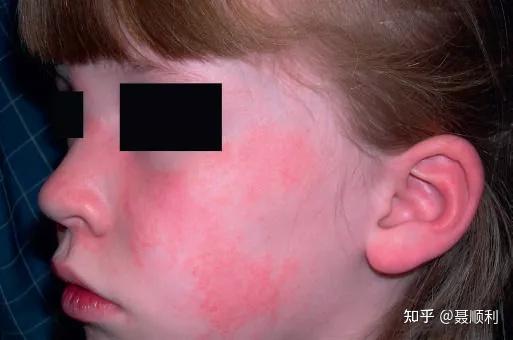 熟悉皮肌炎的皮肤改变少一些误诊上