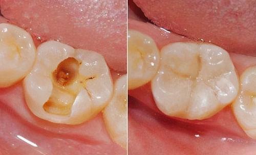 牙齒蛀牙不管會怎麼樣可能產生這3種嚴重危害