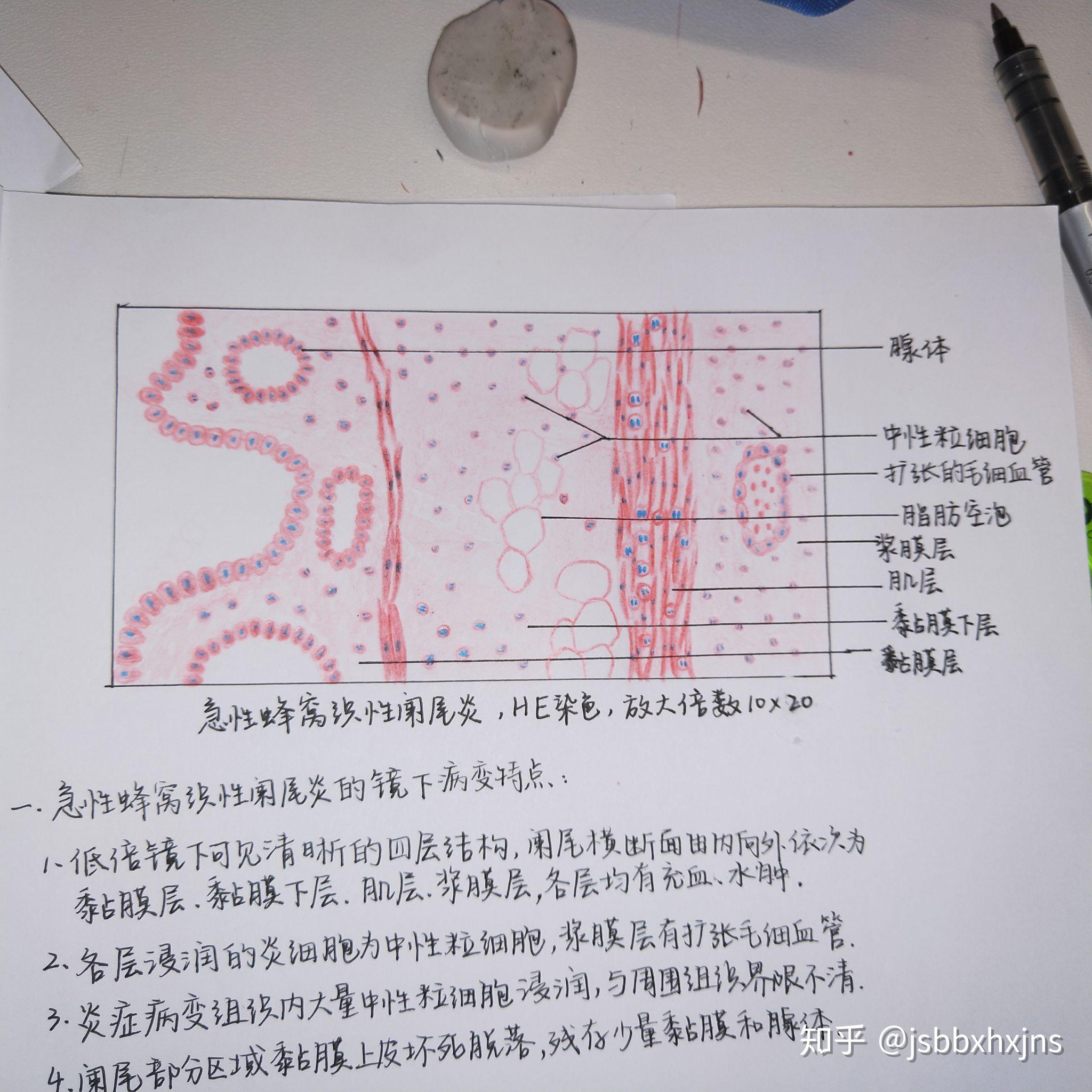 阑尾蜂窝织炎实验画图图片