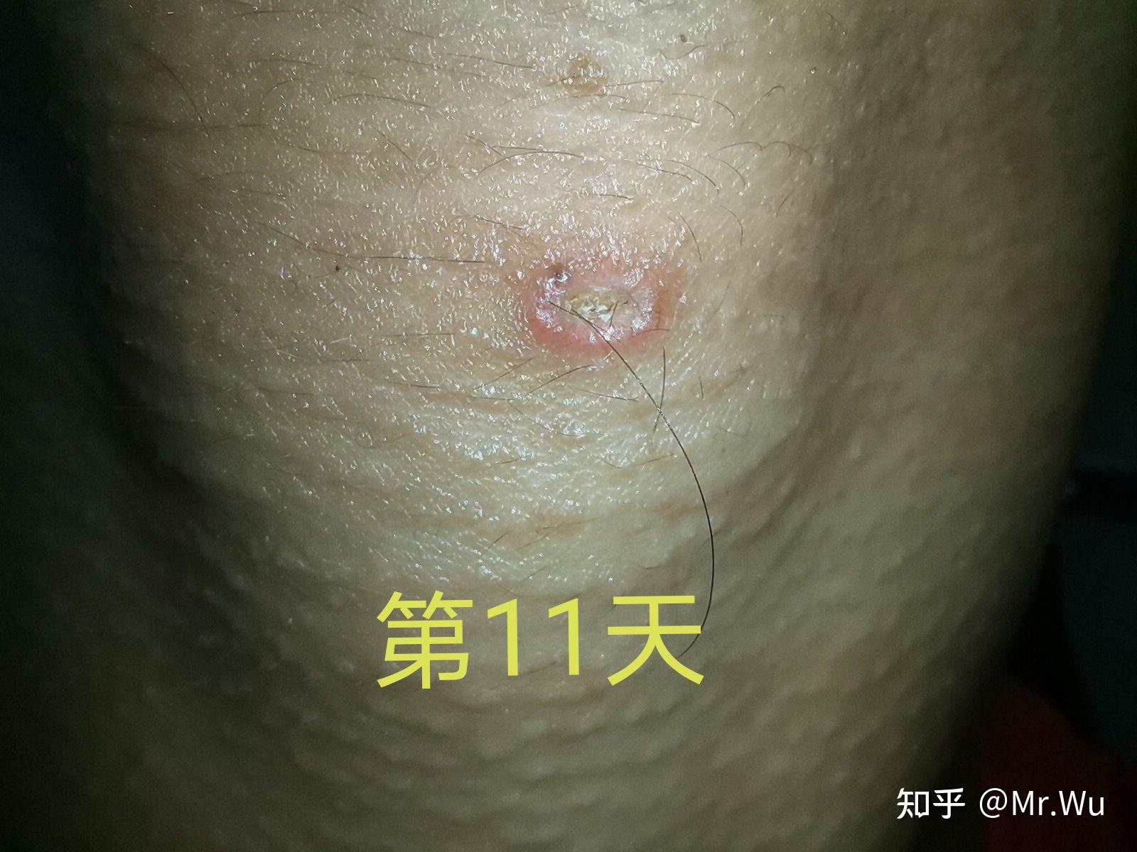 点痣后愈合变化过程跟注意事项个人体会分享 - 知乎