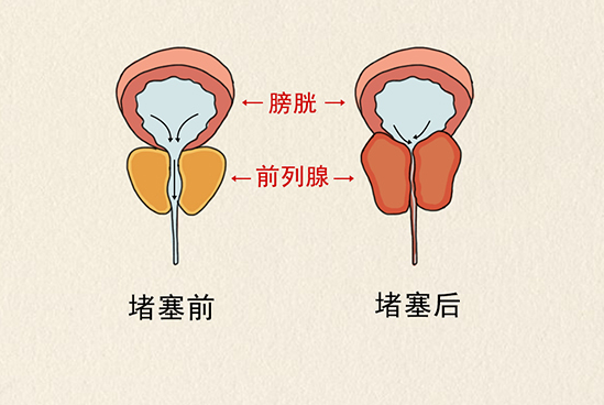 医生说道:由于前列腺腺体增生,堵塞尿道,而且又有便秘现象,所以膀胱中