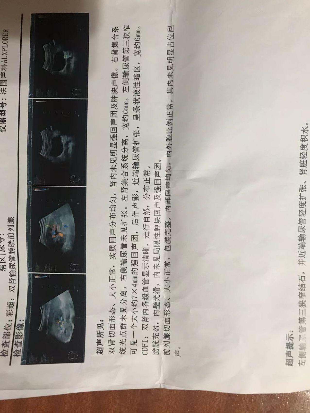 肾结石CT报告图片