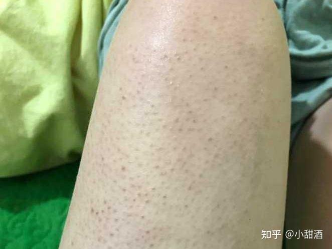 不搓澡身上起鸡皮疙瘩(不搓澡身上起鸡皮疙瘩怎么办)