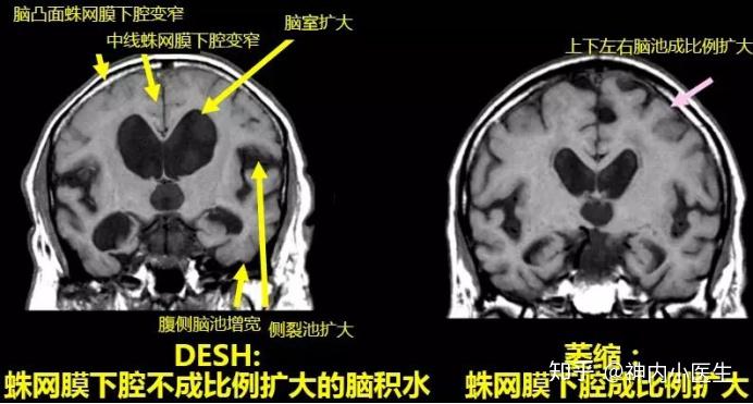 蛛网膜下腔不成比例扩大的脑积水desh-上窄下宽②影像学指标2-特异性