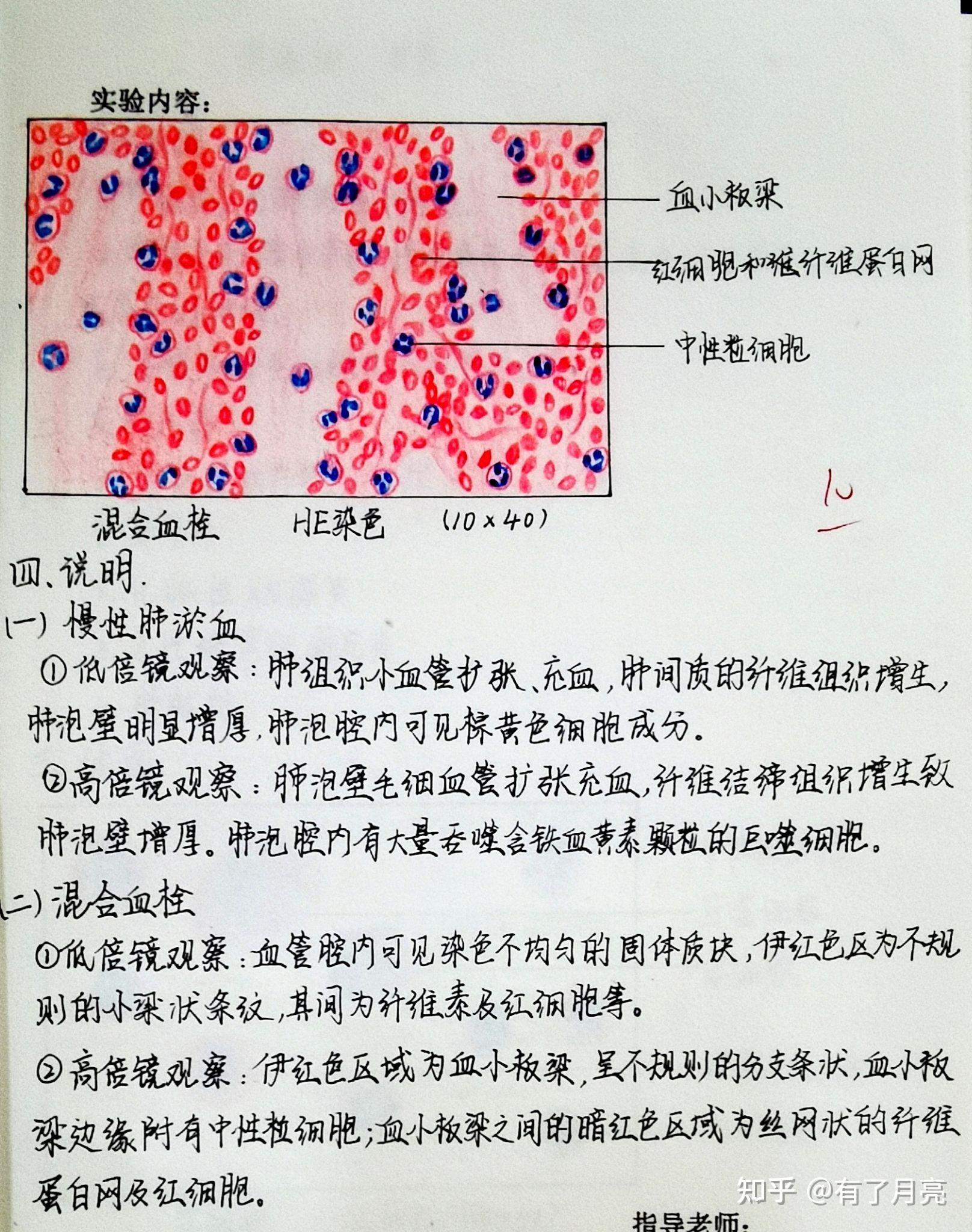 混合血栓绘图图片