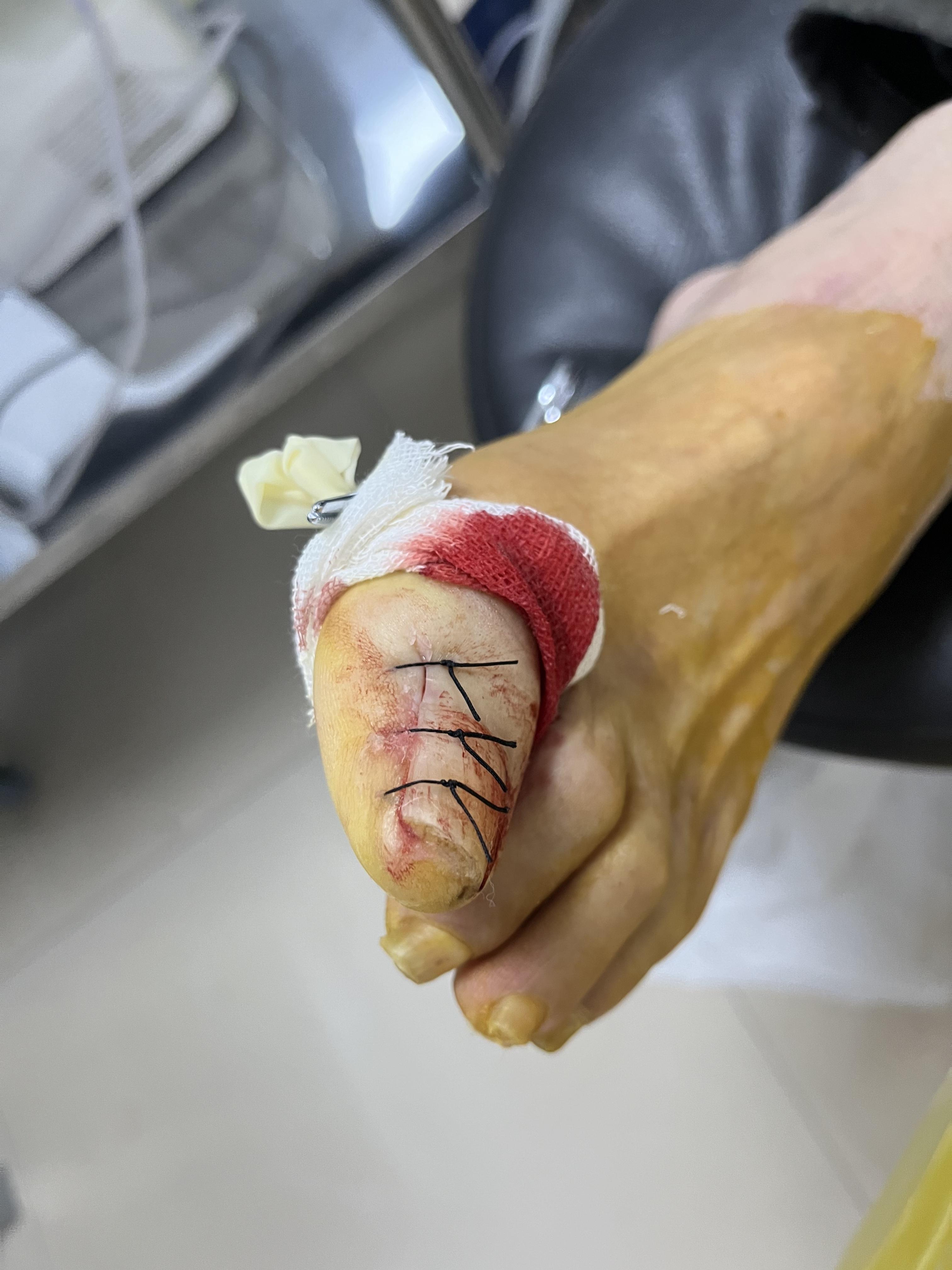 脚上的病基本上除了脚气就是这个甲沟炎