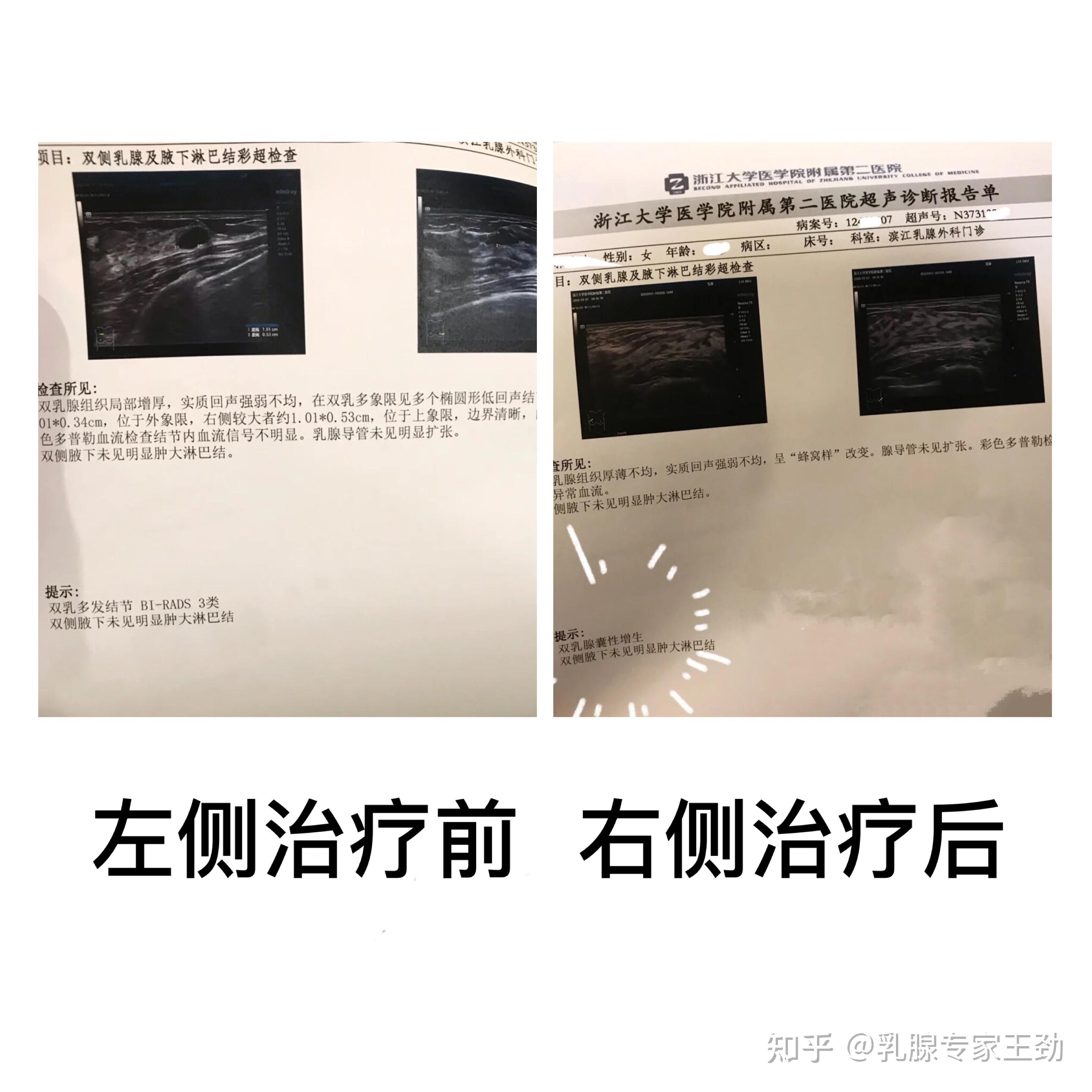 30岁,左右胸部长的对称乳腺结节,治疗过程分享 