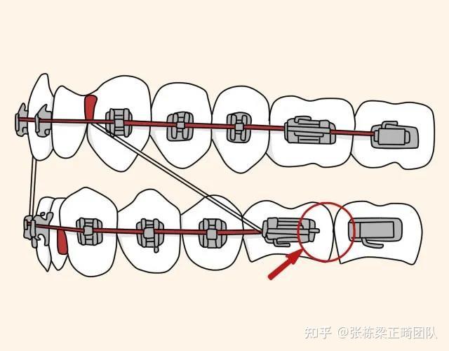 总之,牙齿矫正佩戴橡皮筋可更好地辅助牙齿移位,它是牙齿矫正过程中的