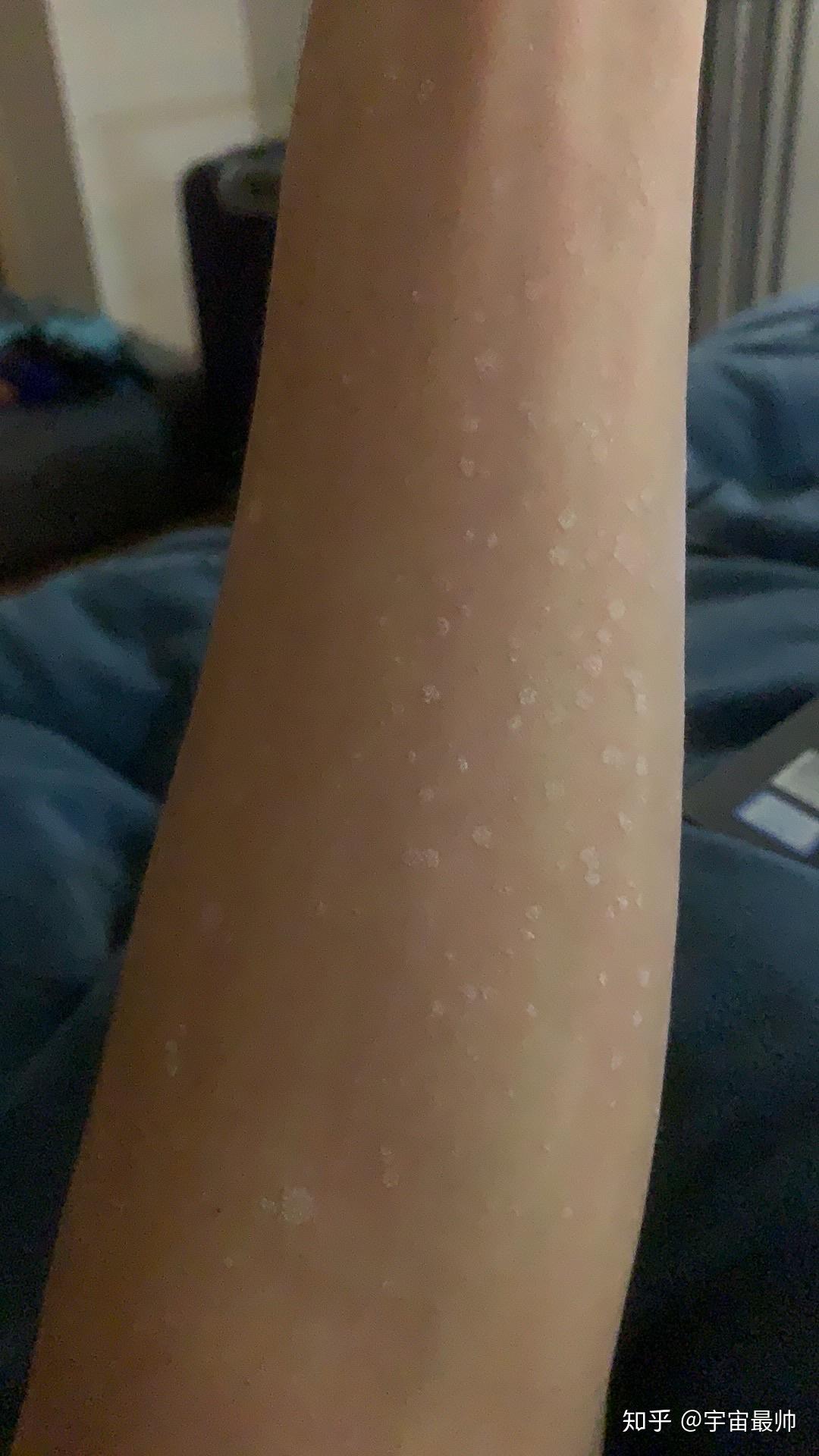 我这是汗斑吗一挠就出现这个平时好像没什么感觉