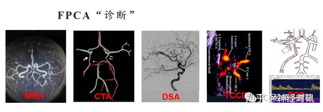 胚胎型大脑后动脉
