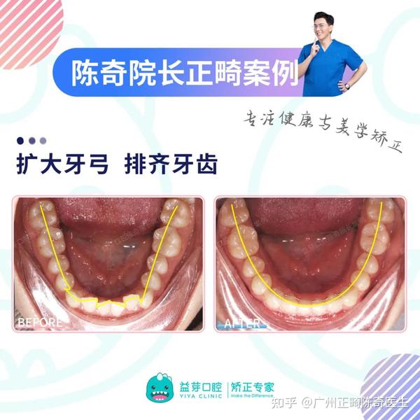 【正畸美学】揭秘“笑线”给笑容带来的变化！一起解锁自信笑容 - 知乎
