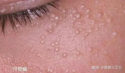 眼周长的小颗粒都是脂肪粒吗