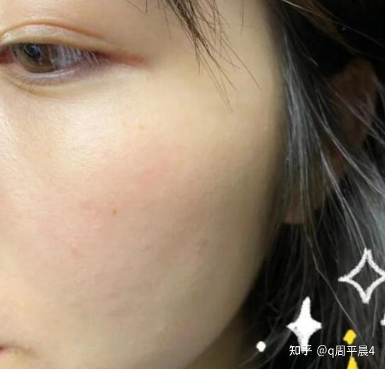 敏感性皮肤,红血丝怎么修复?