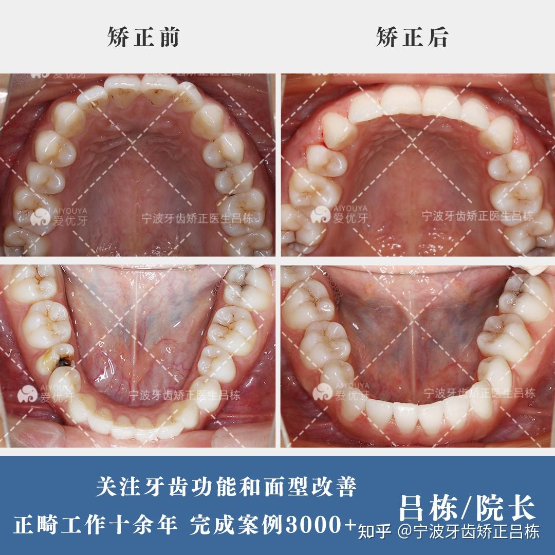 於是方案設計拔除了上4下5雙尖牙,上頜強支抗大幅內收,下頜中度支抗