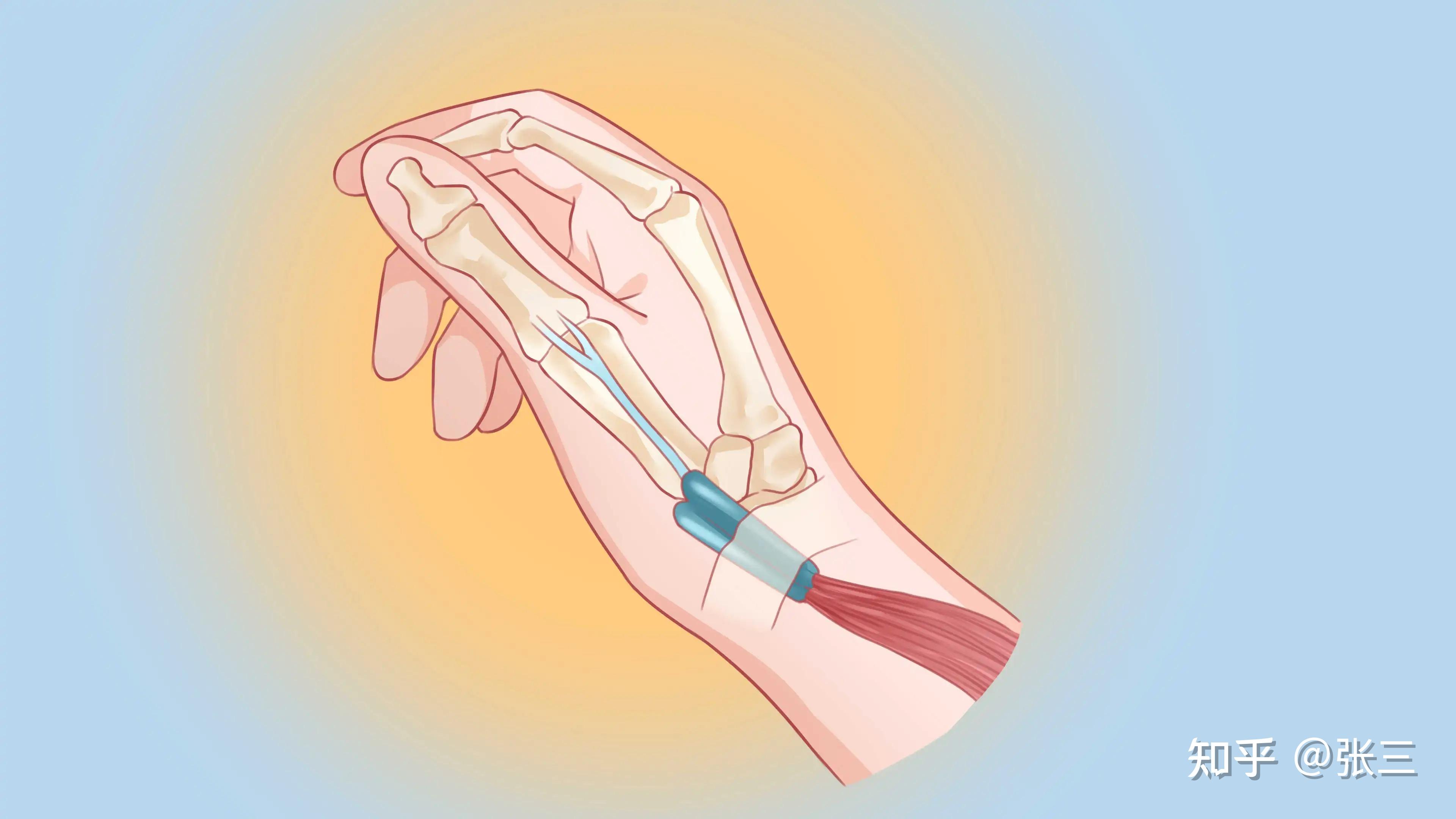 腱鞘炎是怎么产生的?该怎么治疗?