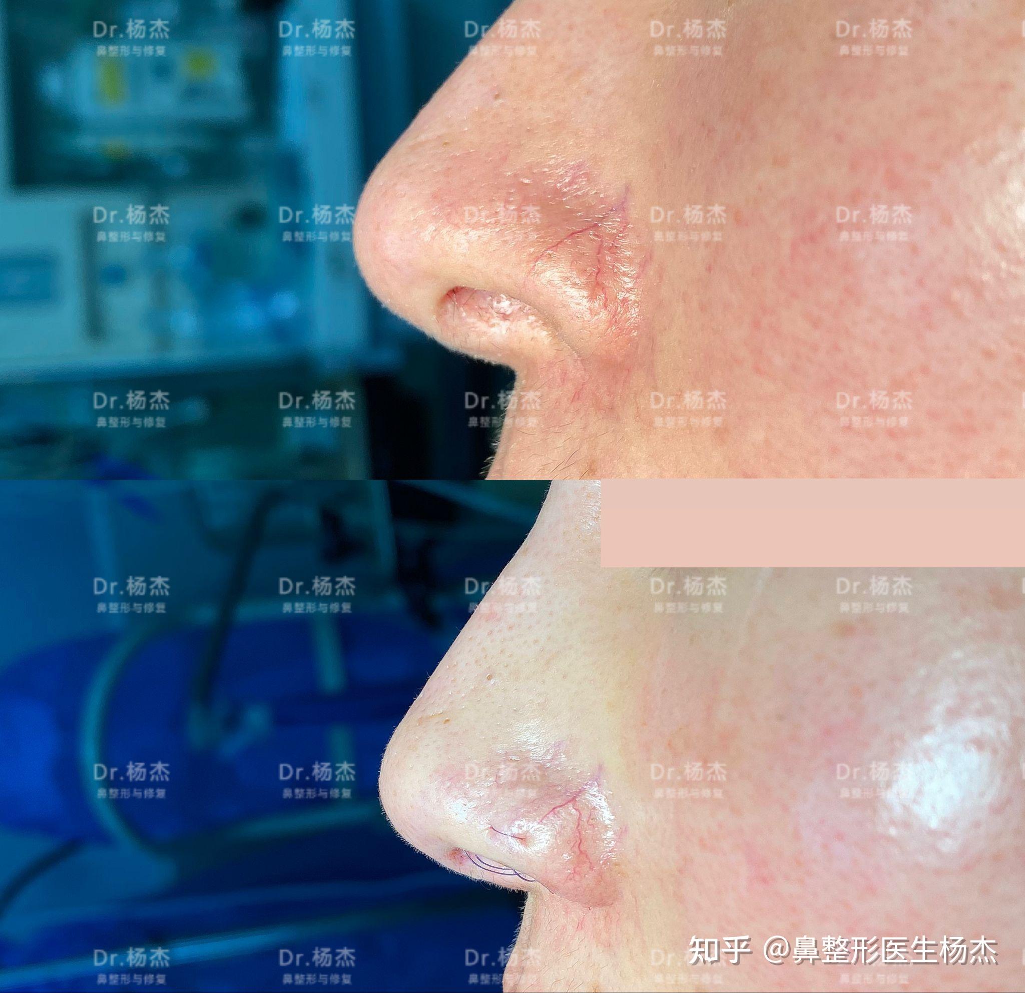 【鼻翼缘退缩矫正】 - 知乎