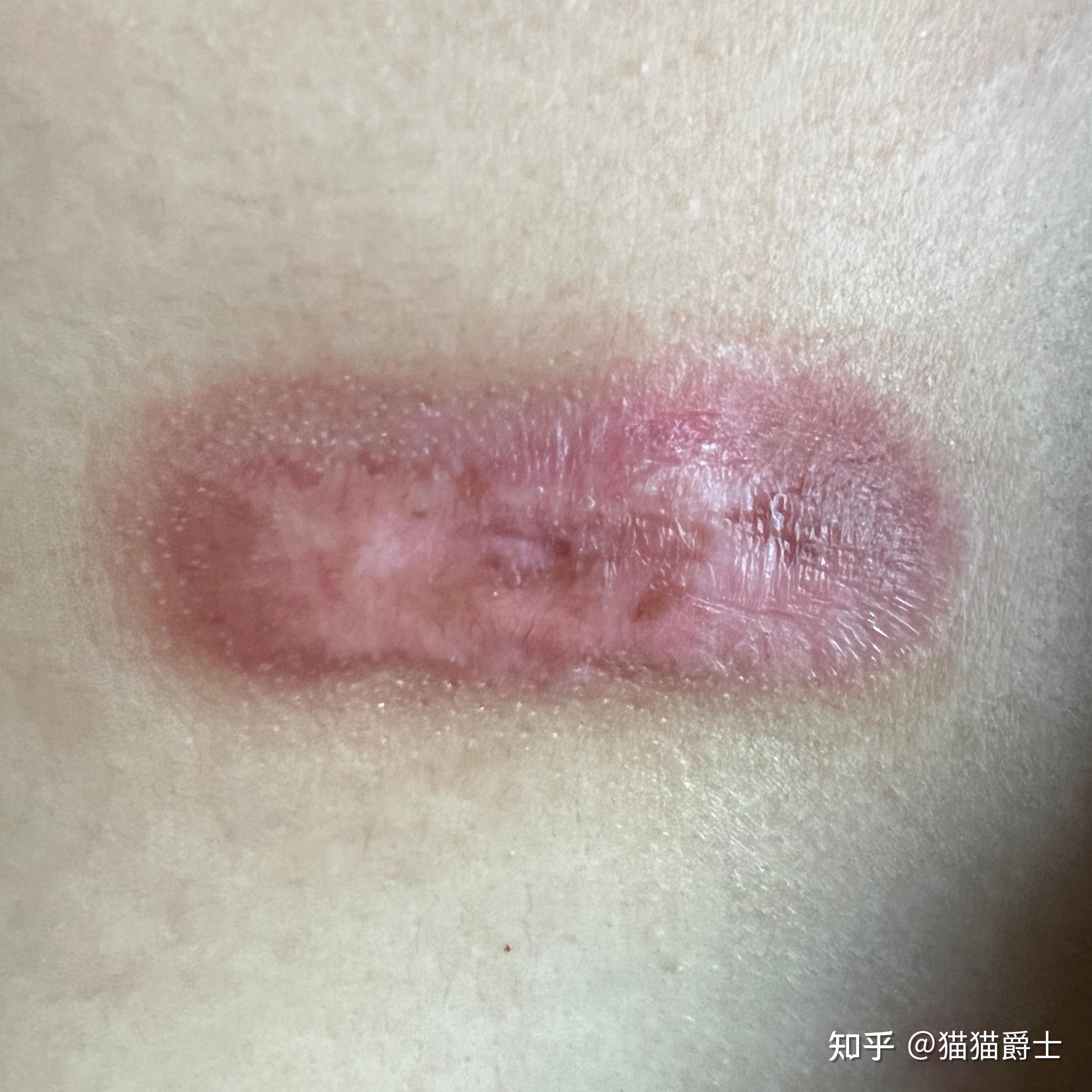 核医学科同位素治疗疤痕疙瘩记录
