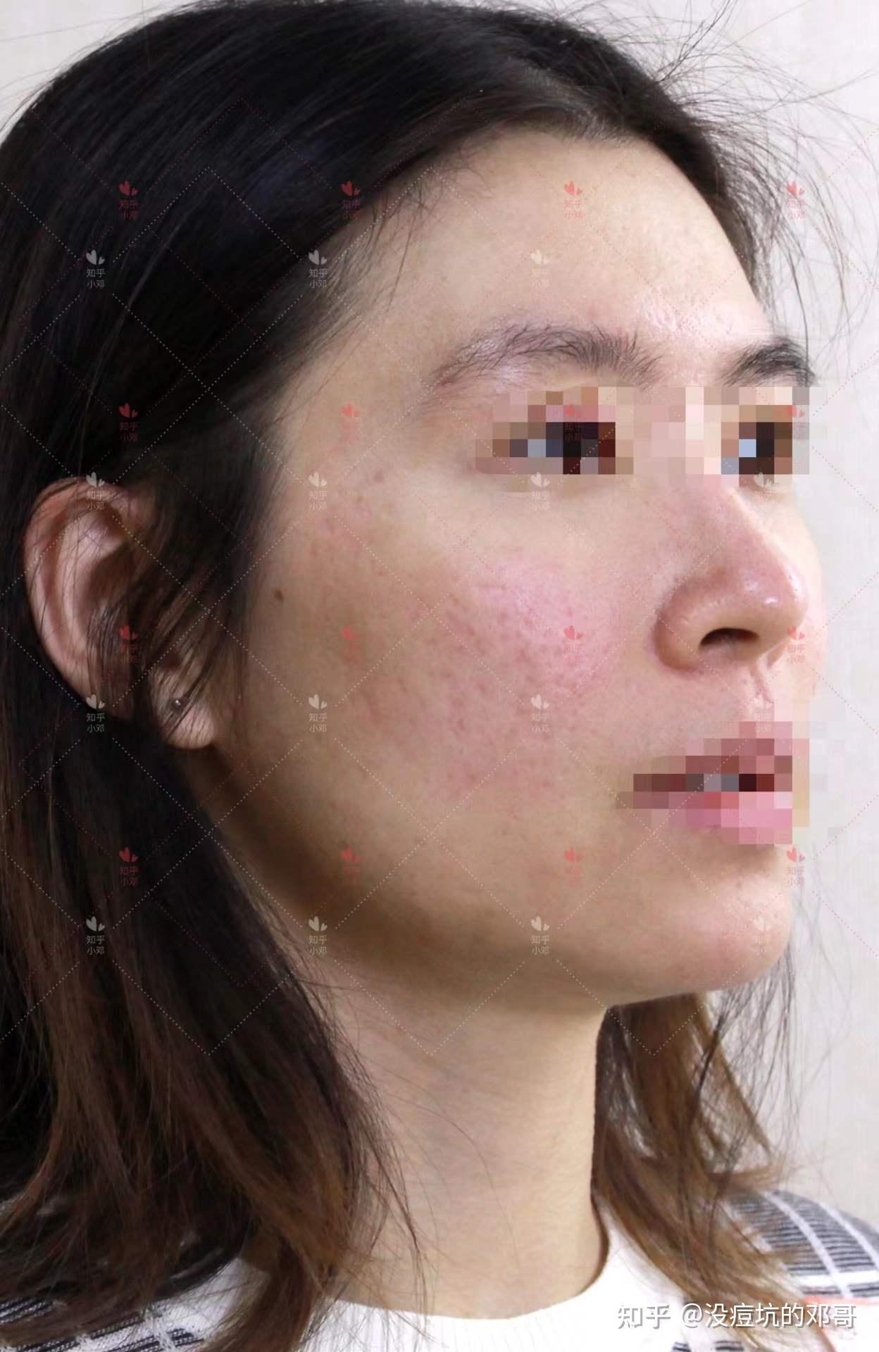 厢车型痘坑治疗两组后的效果反馈图来啦