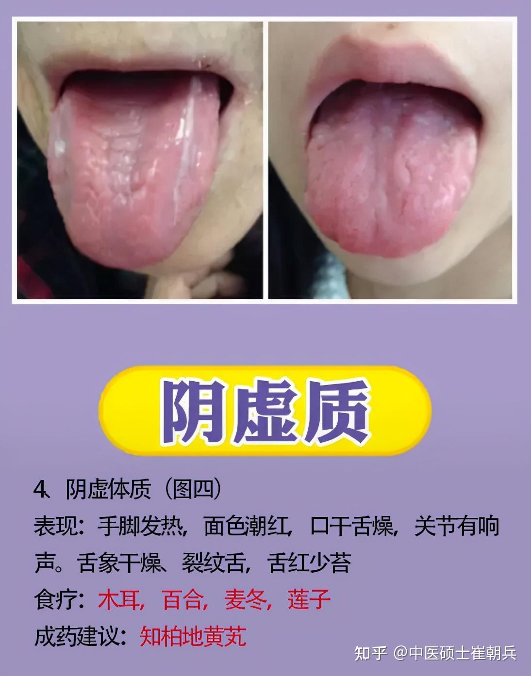 分享9种体质舌象,让老中医教你辨证,后面给你解决方法 - 知乎