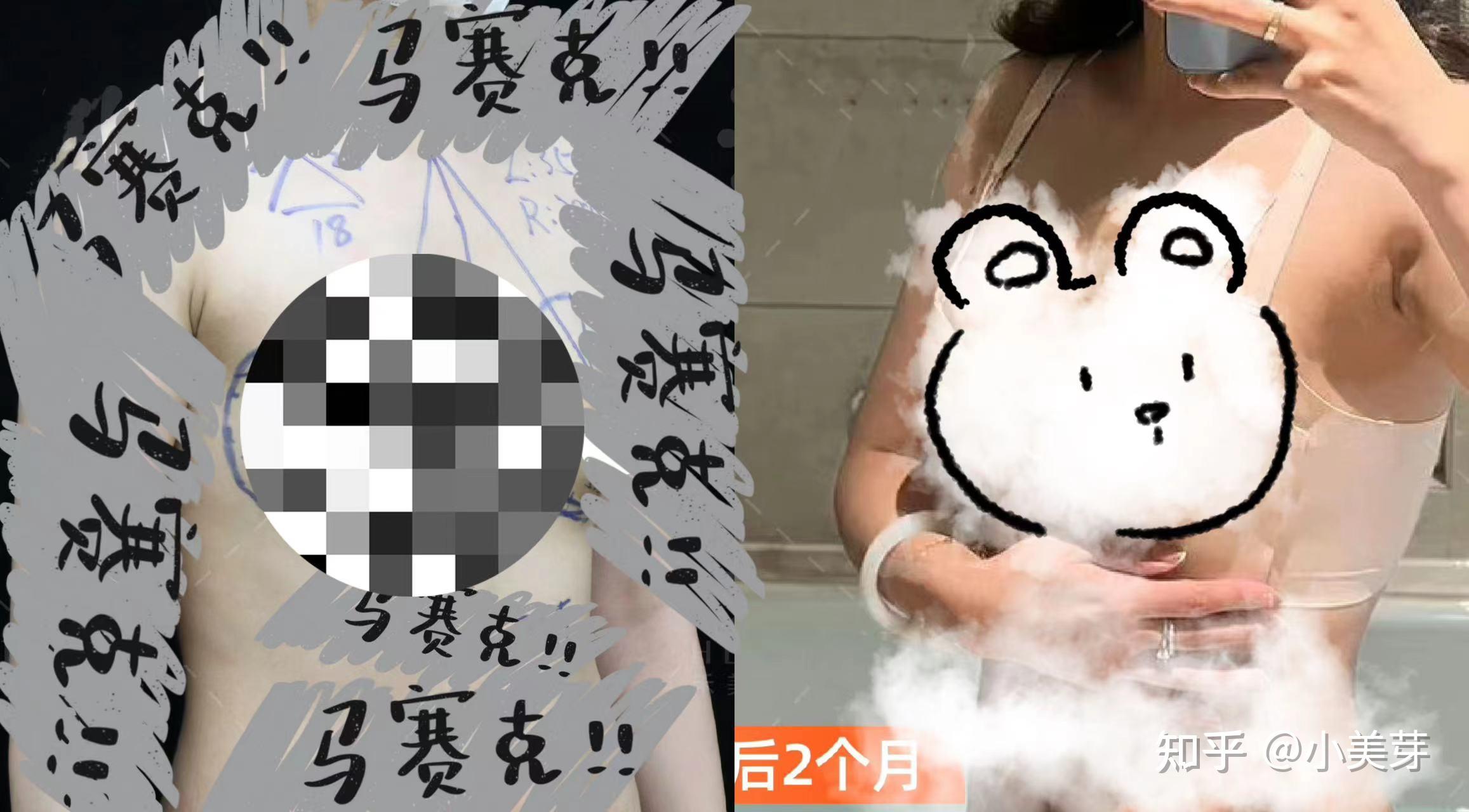 哺乳后胸部干瘪下垂,只有靠隆胸手术才能恢复如初吗?