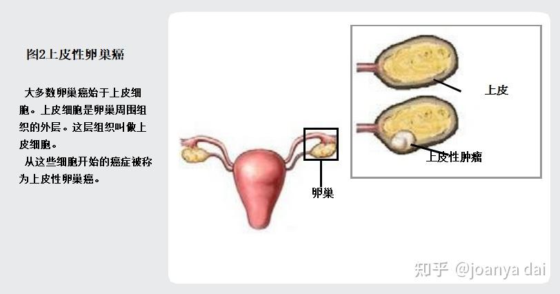 谈癌色变之困扰女性的卵巢癌