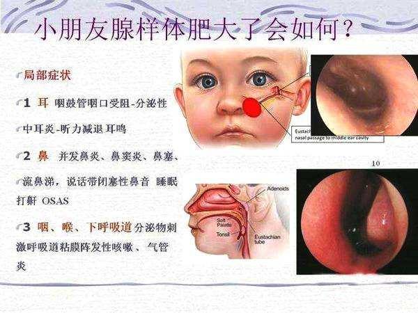 且谈腺样体肥大 知乎