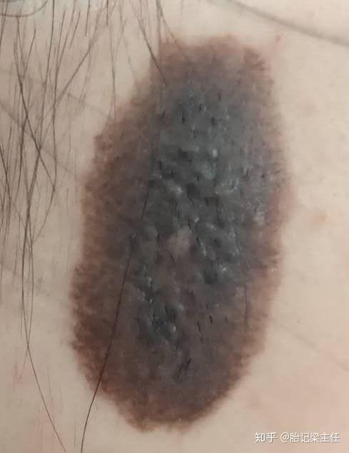 你知道胎记都有哪些危害吗