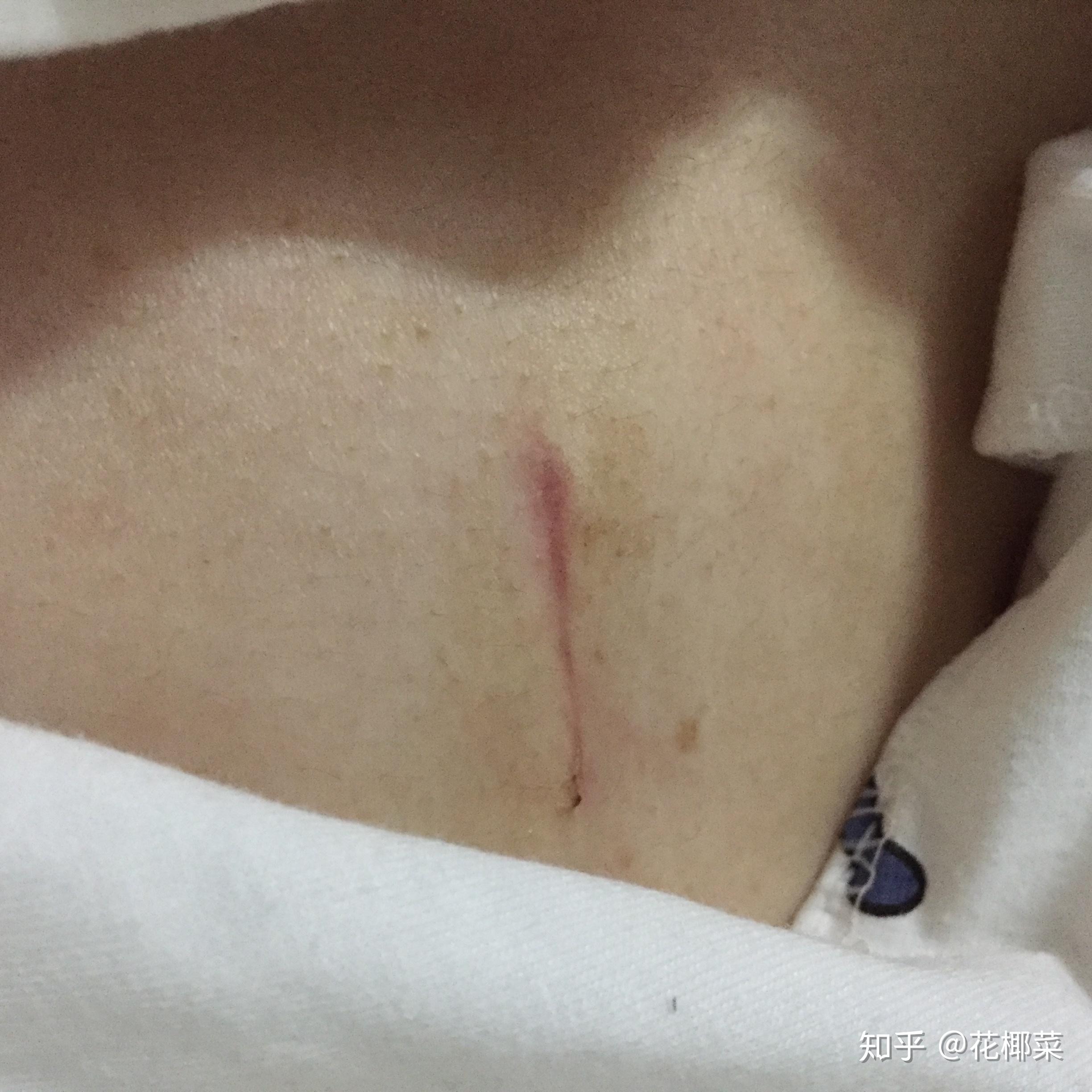 纤维瘤手术后疤痕图片
