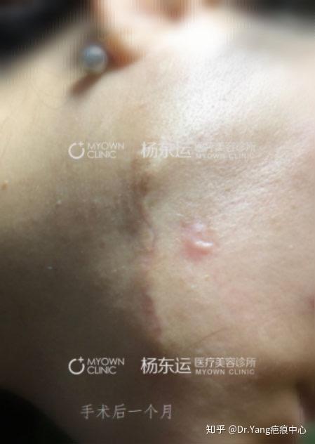 一例下颌明显增生疤痕修复术