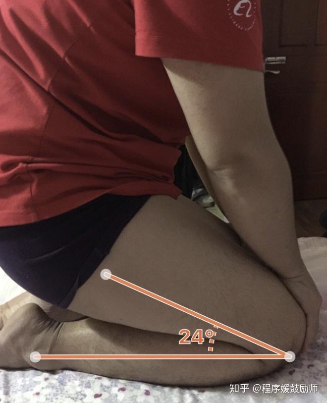 分享如何无痛掰腿压腿如何恢复正常生活楼主胫骨平台六型已恢复