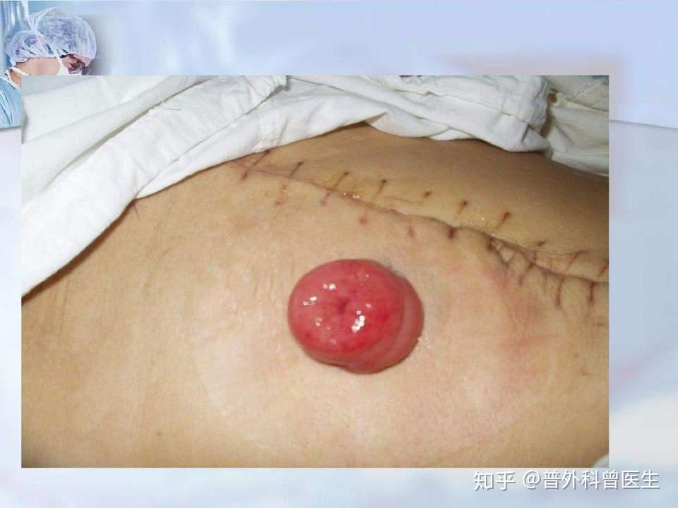 得了直肠癌医生要挖掉我的肛门以后还怎么排便宁死不做手术