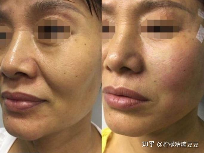 法令纹面部松弛做热玛吉真的有效果吗热玛吉和欧洲之星哪个抗衰效果更