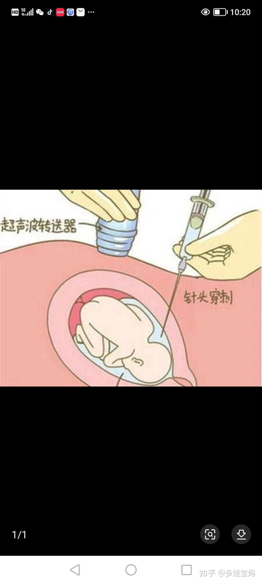 上海长宁妇幼保健院羊水穿刺攻略：手术流程、费用参考、注意事项、结果报告等 - 知乎