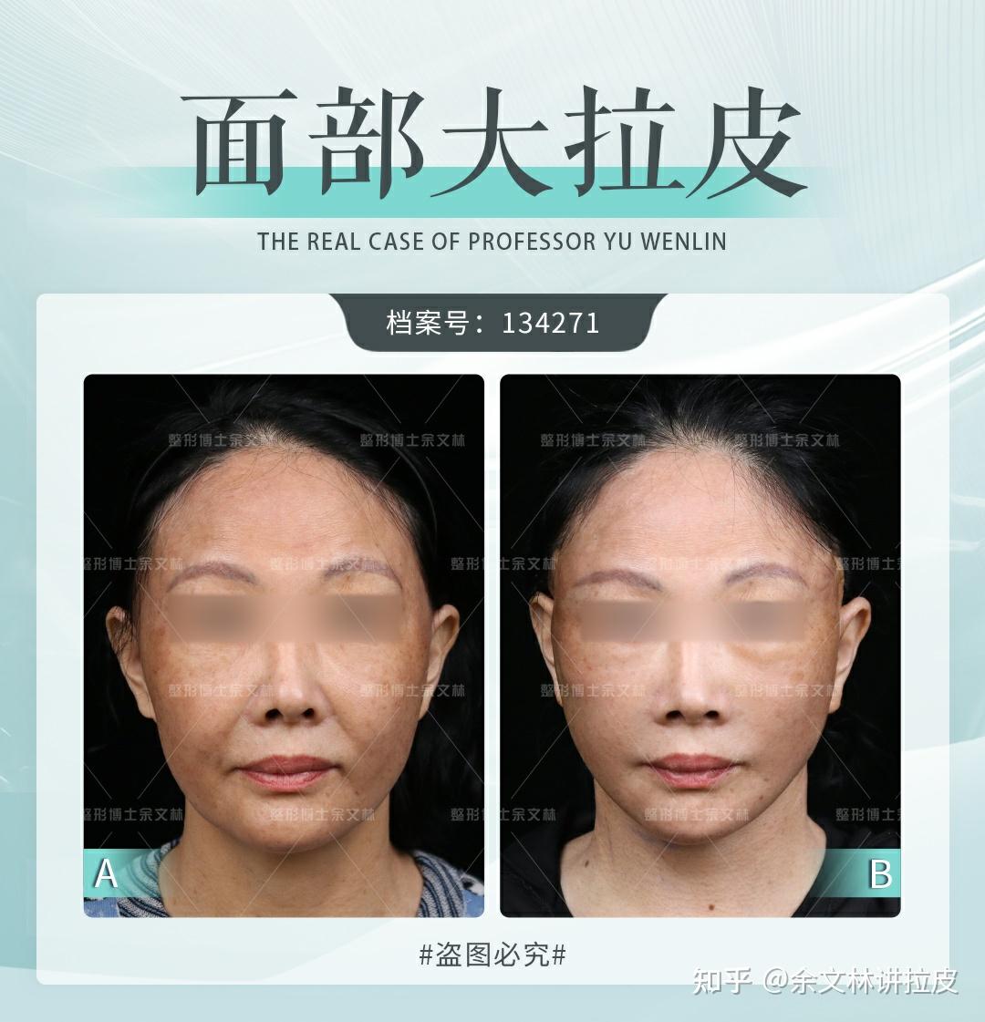 大拉皮vs小拉皮三大招让你秒懂