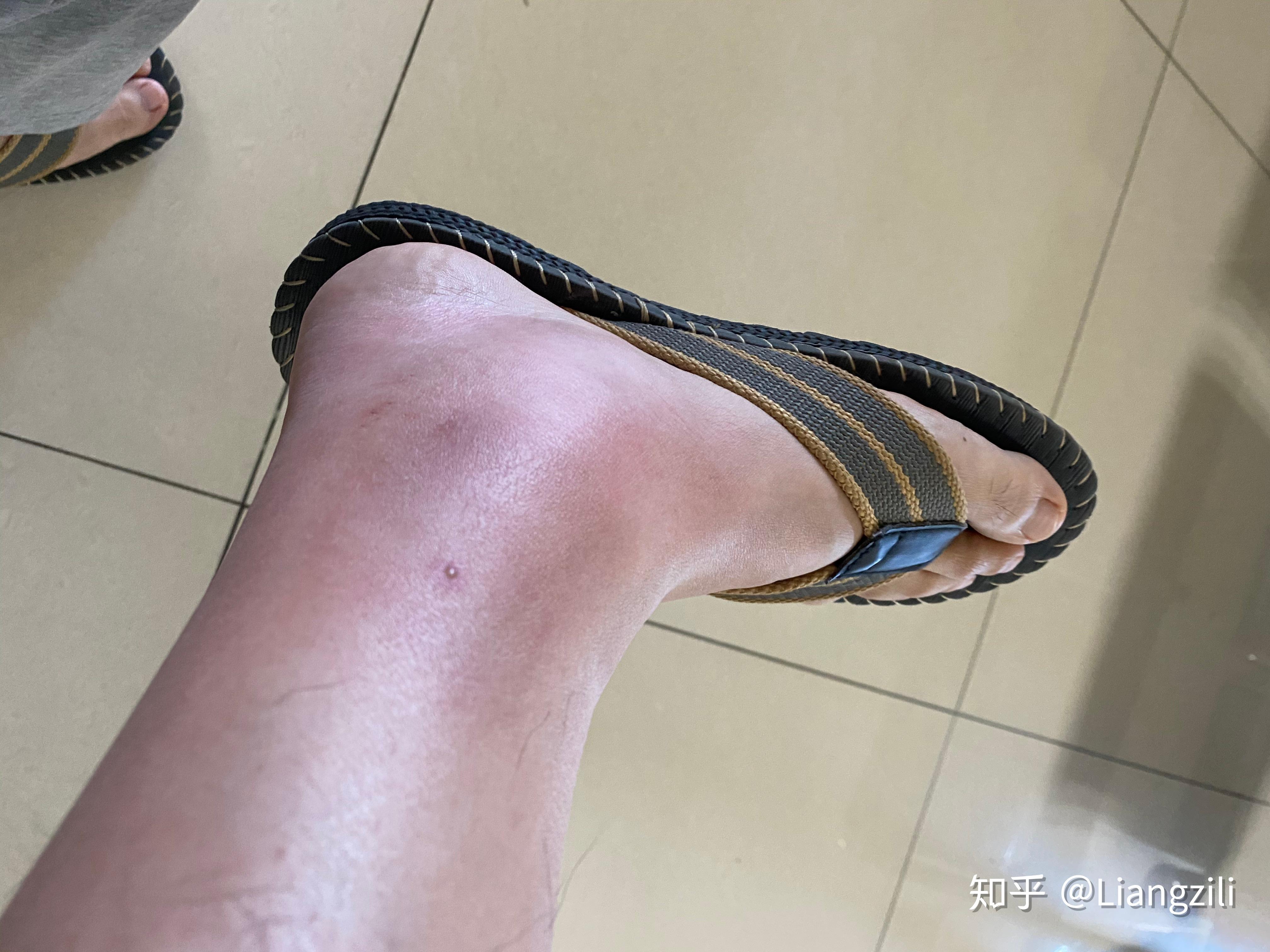 被马蜂蛰了是种什么体验