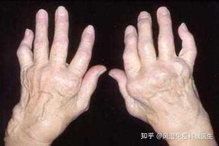 类风湿关节肿胀变形了是不是畸形残疾的信号