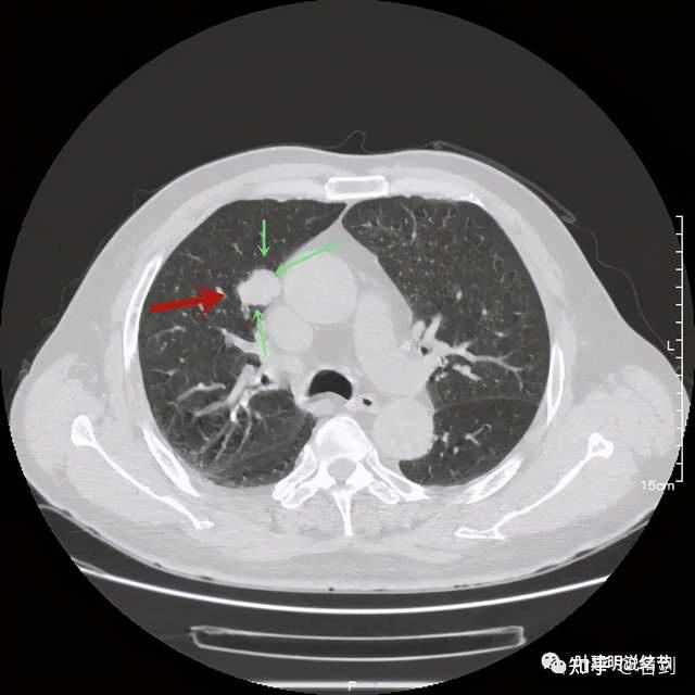 误诊分析202166不一样的错构瘤
