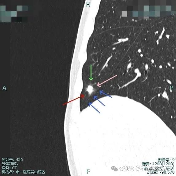 肺部实性结节图片图片