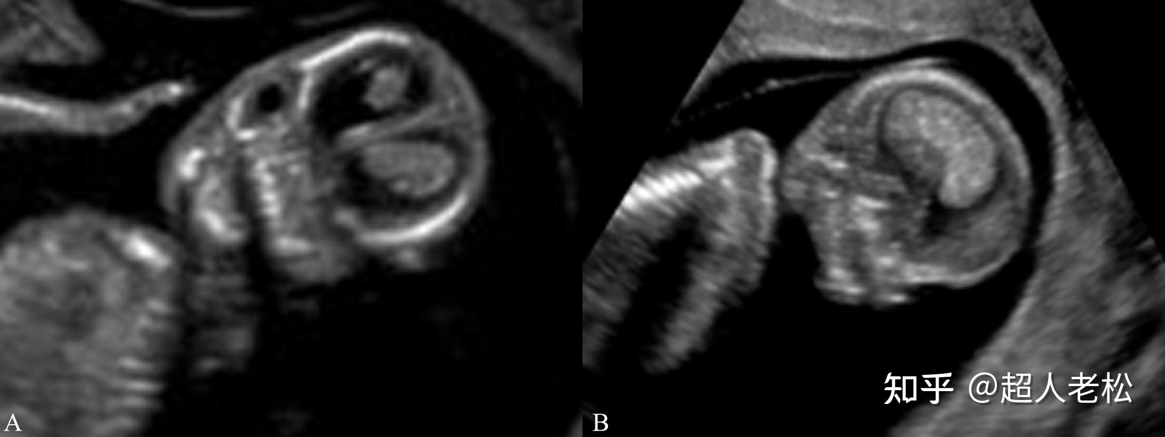 胎儿透明隔腔超声检查专家共识|胼胝体|超声|胎儿|检查|脑室|畸形|-健康界