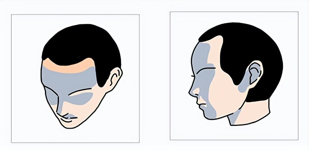 发际线后移尺寸如何测量?